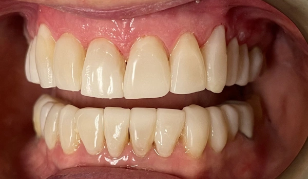 Patient smile after Aspect Veneers with balanced tooth shape and improved alignment