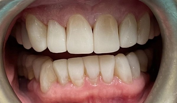 Teeth after dental treatment with brighter, smoother appearance