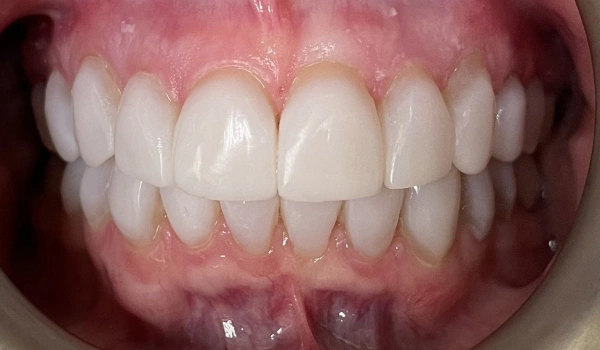 Teeth after dental treatment showing a bright, healthy smile