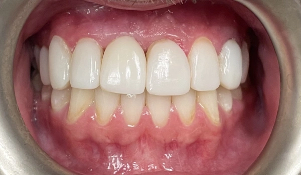 Tooth restored after dental treatment