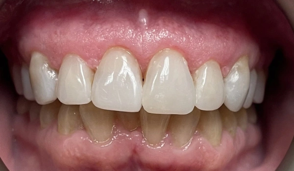 Teeth after dental treatment showing brighter and healthy