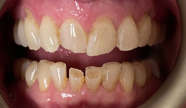 Teeth before dental treatment showing discoloration and broken