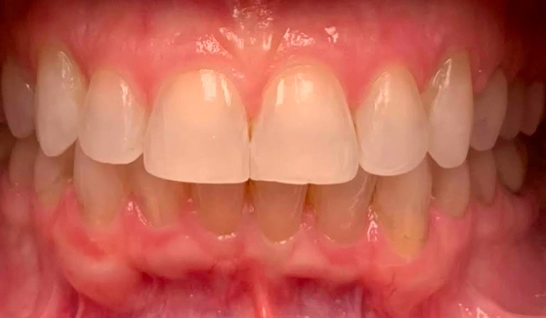 Teeth before dental treatment showing discoloration