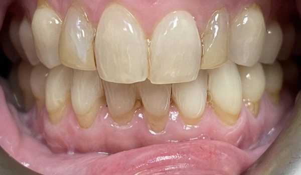 Teeth before dental treatment showing discoloration