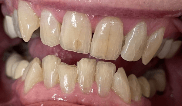 Teeth before dental treatment with discoloration and uneven edges