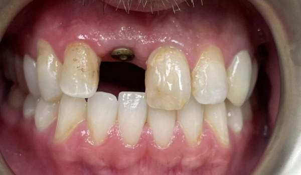 Missing tooth before dental treatment