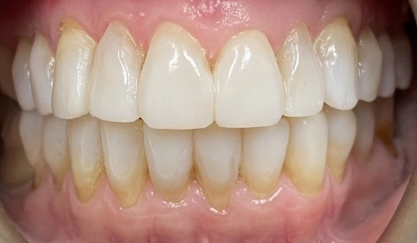 Patient’s teeth after dental restoration with improved color