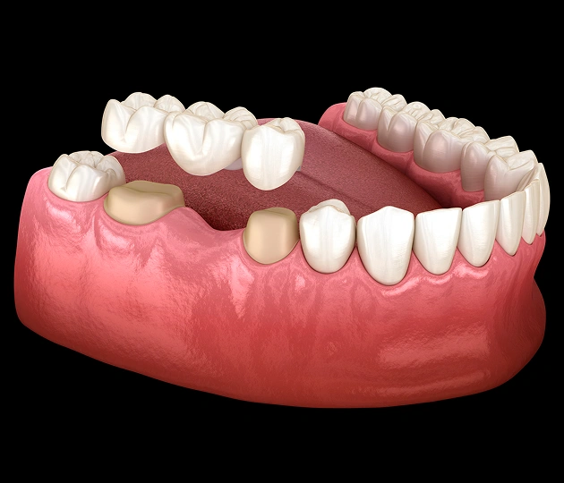 Dental Bridges