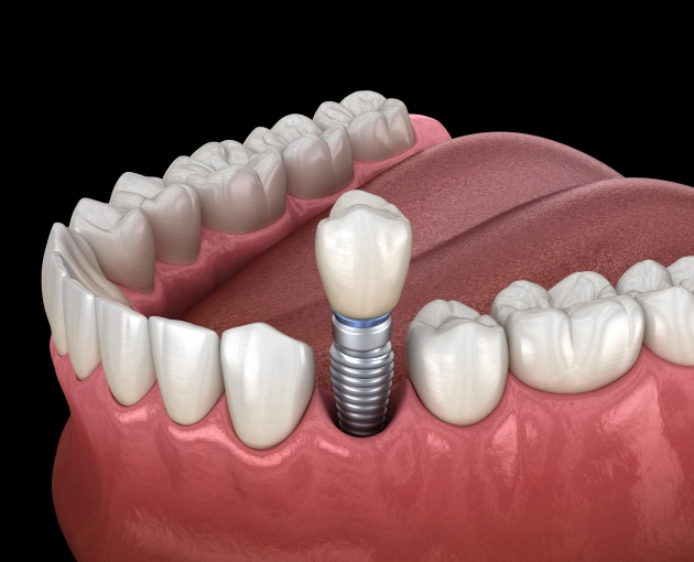 Dental implants