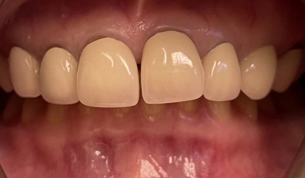 Close-up of discolored before dental treatment