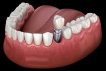 single tooth implants