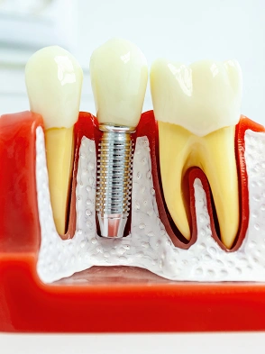 Dental Implants