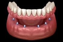 dental implant supported dentures