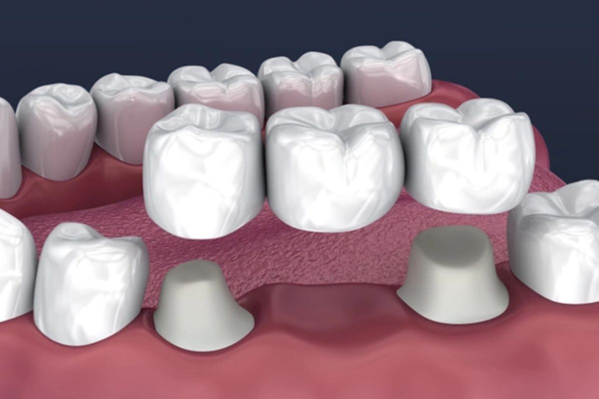 how long does a dental bridge last